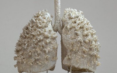 Popcorn Lungs